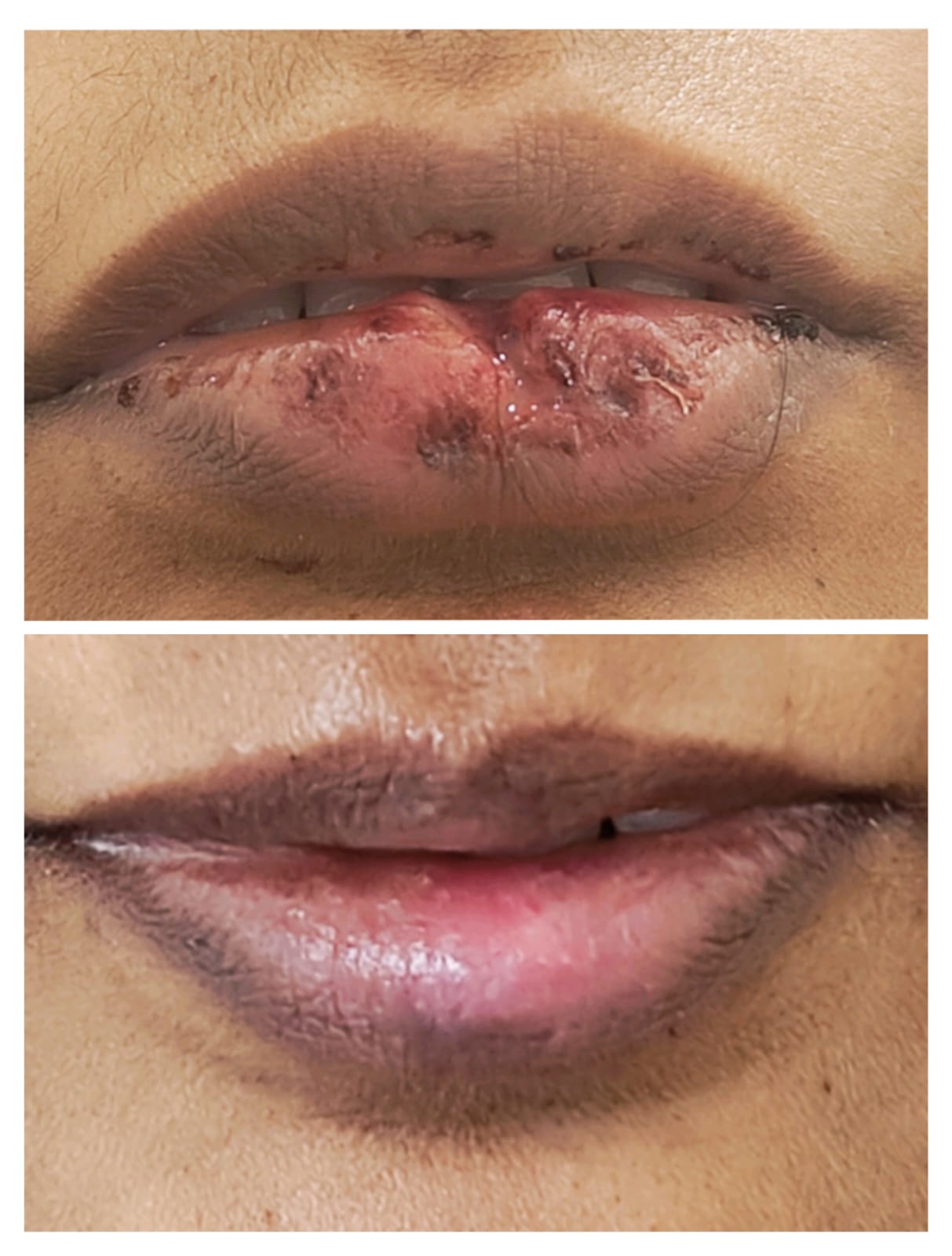 Lip injury repair